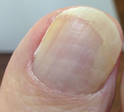 Beschädigter durch Nagelpilz Fußnagel in 15 Min. mit dem Fußnagel Spray/Jenn Cos