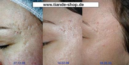 Serie gegen Akne Natur-Kosmetik - effektiv gegen Pickeln, Mitesser und Narben
