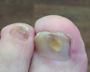 Beschädigter durch Nagelpilz Fußnagel in 15 Min. mit dem Fußnagel Spray/Jenn Cos