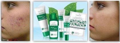 Serie gegen Akne Natur-Kosmetik - effektiv gegen Pickeln, Mitesser und Narben