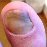 Beschädigter durch Nagelpilz Fußnagel in 15 Min. mit dem Fußnagel Spray/Jenn Cos