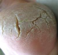 Mobile Fußpflege zum Wohlfühlen Petra Berwanger